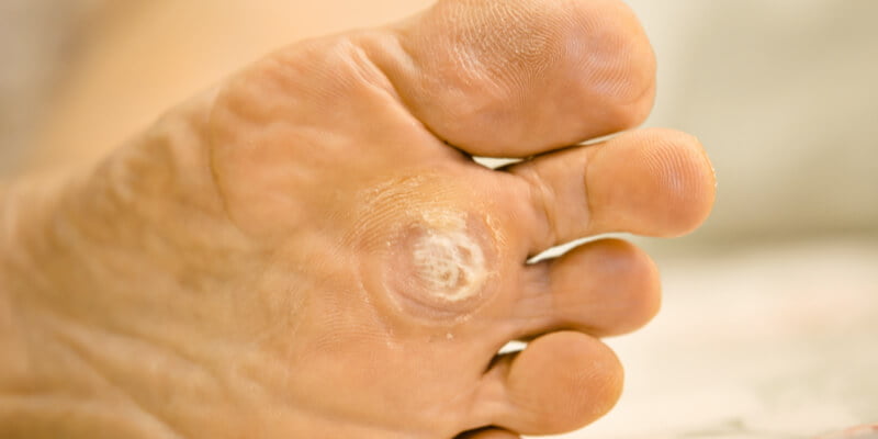 Que es papiloma en los pies, Verrugas en pies y manos: tratamientos y causas papilloma a mellben